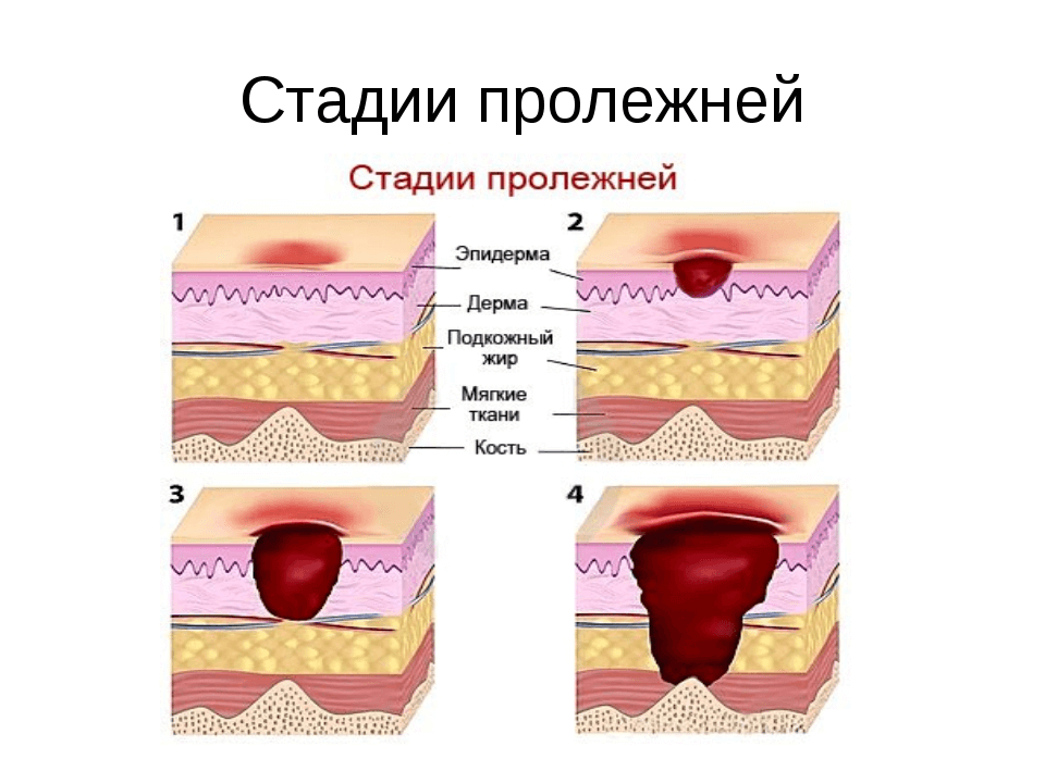 Стадии пролежней